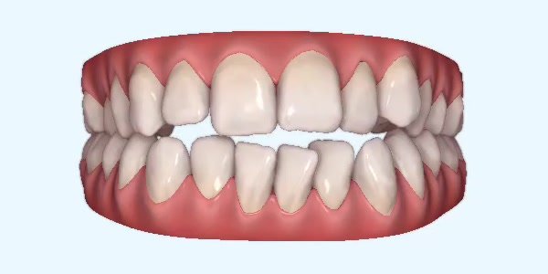 Crossbite Cases