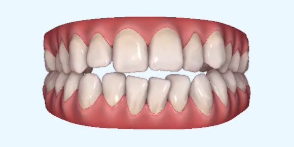 Crossbite Cases