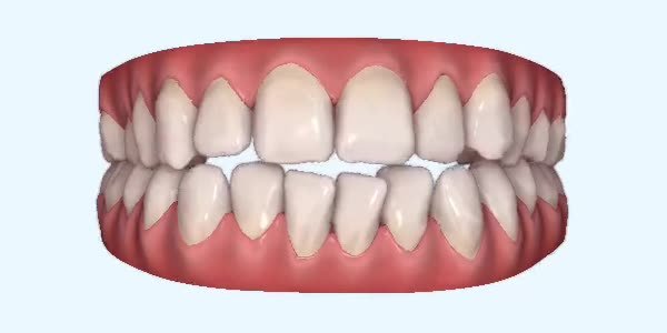 Crossbite Cases
