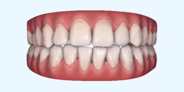 Crossbite Cases