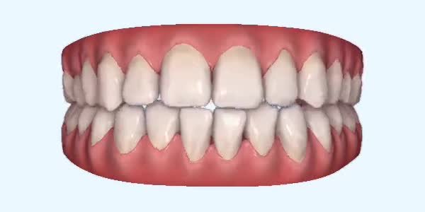 Crossbite Cases