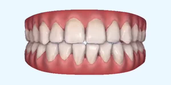 Crossbite Cases