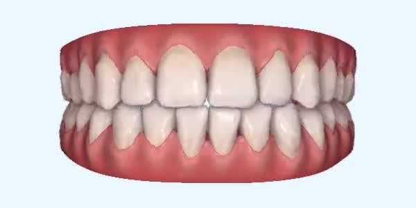 Crossbite Cases