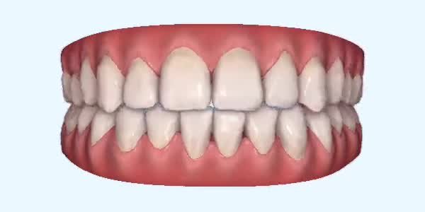 Crossbite Cases