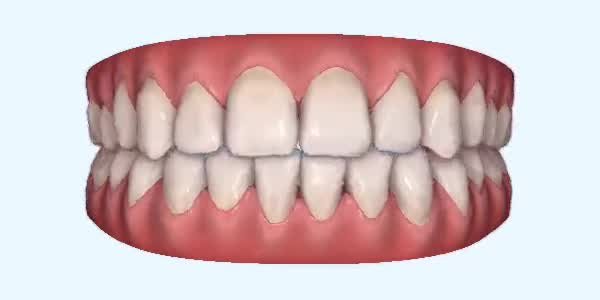 Crossbite Cases