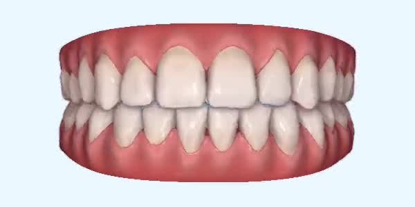 Crossbite Cases