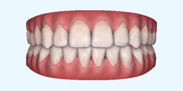 Crossbite Cases